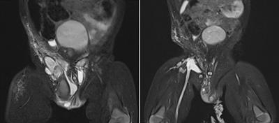 Case report: A rare case of multifocal, combined lymphatic-venous malformation